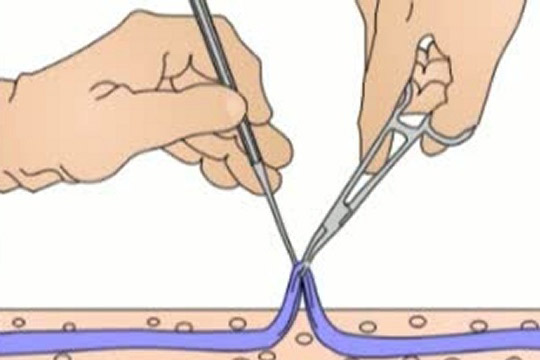 Cərrahi əməliyyat